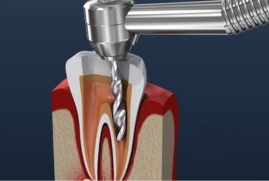 Root Canal Treatment in Pune | Painless RCT Cost & Procedure